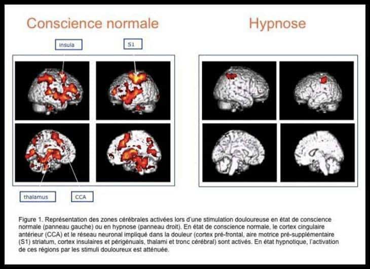 Imagerie cérébrale de la douleur avec et sans hypnose